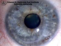 Eccentric Penetrating Keratoplasty